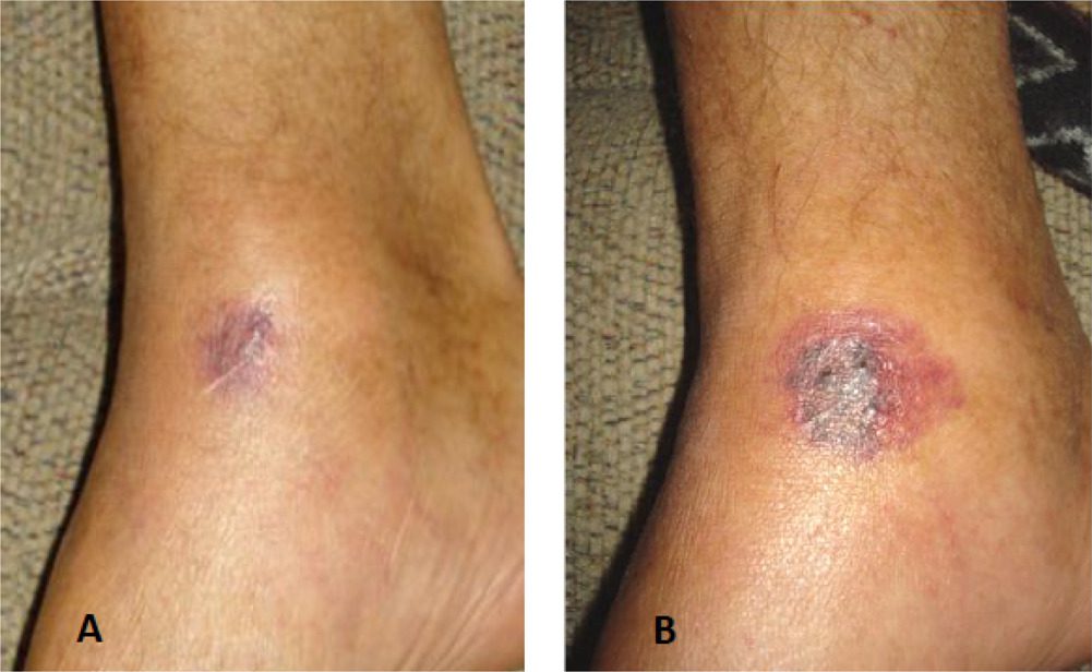 Initial stages of a fatal V. vulnificus wound infection. The photograph (panel A) shows initial erythema associated with the early stages of infection. The progression of the infection (B) is rapid, and was taken 4 h and 15 min later, showing more extensive erythema of the lesion.
